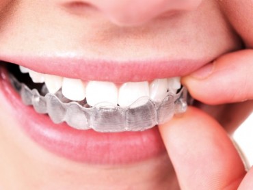 invisalign-01.jpg