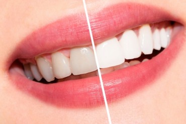 blanqueamiento-dental.jpg
