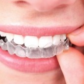 invisalign-01.jpg