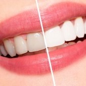 blanqueamiento-dental.jpg