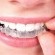 invisalign-01.jpg