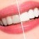 blanqueamiento-dental.jpg