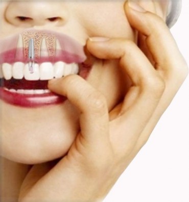 Tratamientos-de-implantes-dentales.jpg