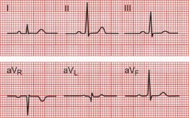 ECG1.jpg